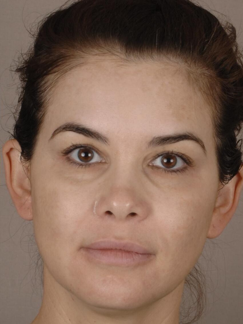 Microneedling Client After