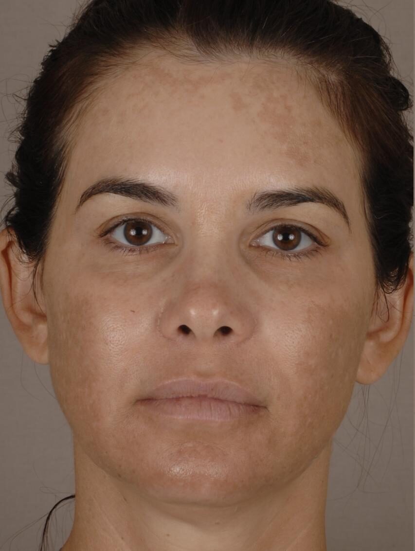 Microneedling Client Before